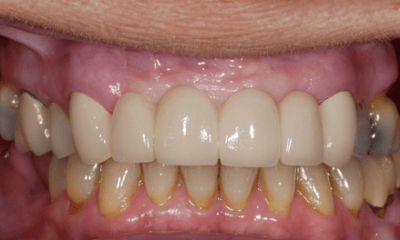 After treatment - Porcelain Bridge