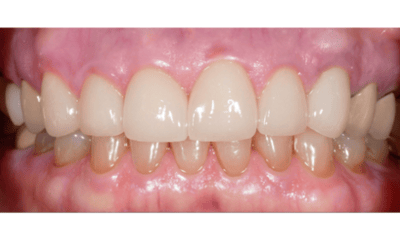 After treatment - Porcelain Veneer Smile Makeover
