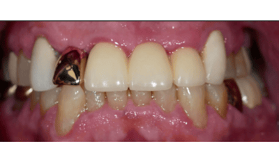 After treatment - Front Tooth Implant & Crown