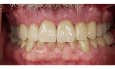 After treatment - Smile Makeover with Porcelain Crowns