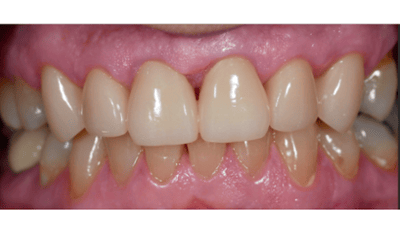 After treatment - Smile Restoration with Porcelain Crowns
