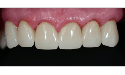 After treatment - Smile Restoration with Porcelain Crowns