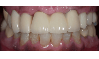 After treatment - Upper Implant Bridge Restoration