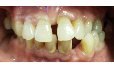 Before treatment - All-on-4 Smile Makeover