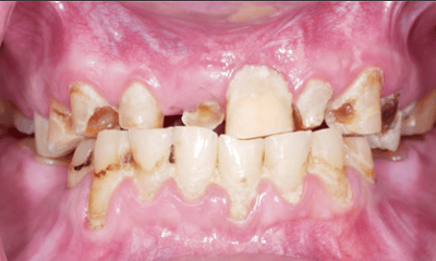 Before treatment - All-on-4 Smile Makeover