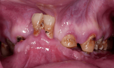 Before treatment - Complete Denture Restoration