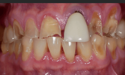 smile makeover dental case- before photo