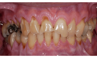 Before treatment - Complete Smile Makeover
