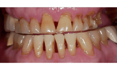 Before treatment - Complete Smile Restoration