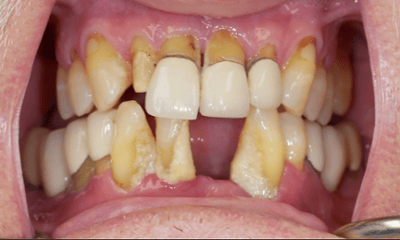 Before treatment - Full-Mouth Implant Smile Makeover