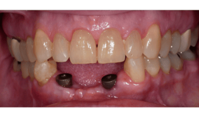 Before treatment - Lower Implant Bridge Restoration