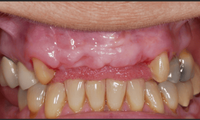 Before treatment - Porcelain Bridge