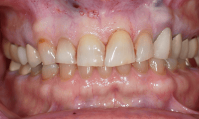 Before treatment - Porcelain Veneer Smile Makeover