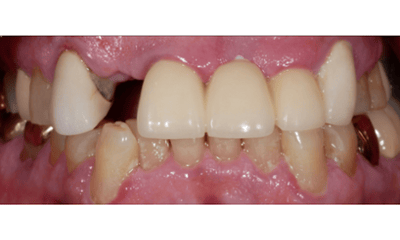Before treatment - Front Tooth Implant & Crown