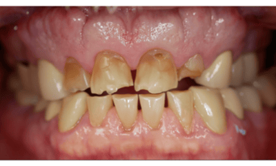 Before treatment - Smile Makeover with Porcelain Crowns