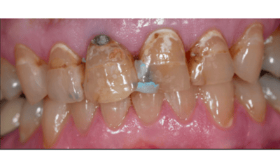 Before treatment - Smile Restoration with Porcelain Crowns