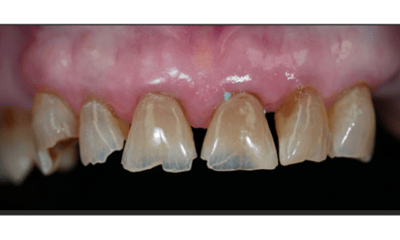 Before treatment - Smile Restoration with Porcelain Crowns