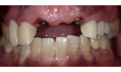 Before treatment - Upper Implant Bridge Restoration